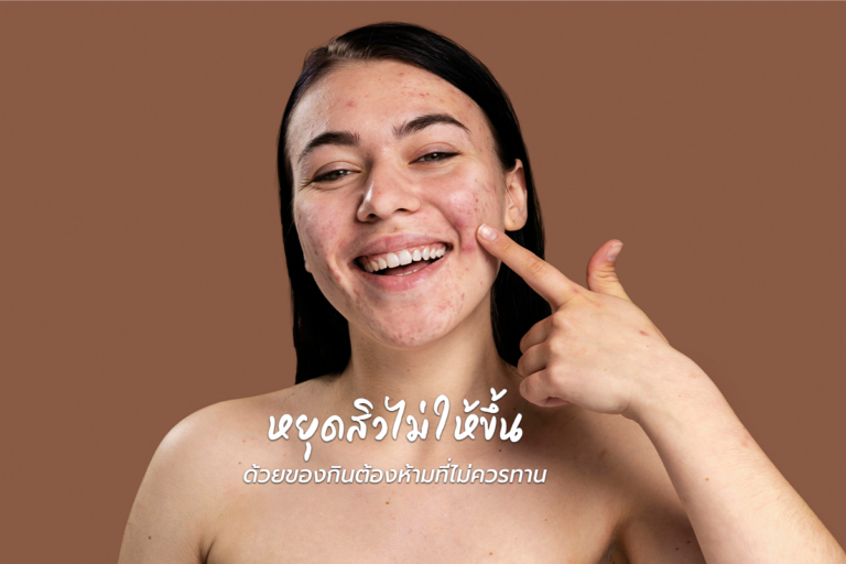 หยุดสิว (acne) ไม่ให้ขึ้น ด้วยของกินต้องห้ามที่ไม่ควรทาน