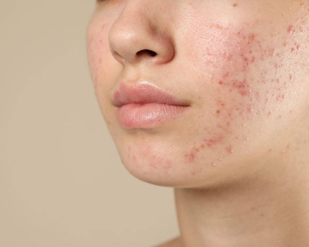 บอกลารอยสิว ฝ้า กระ ด้วย Pico Laser เผยผิวเรียบเนียนอย่างมั่นใจ